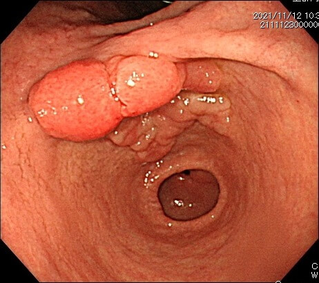 粘膜下層へ浸潤した早期胃がん