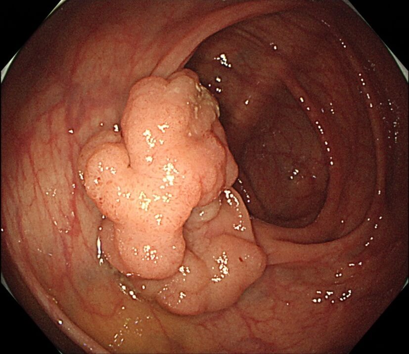 早期大腸がん